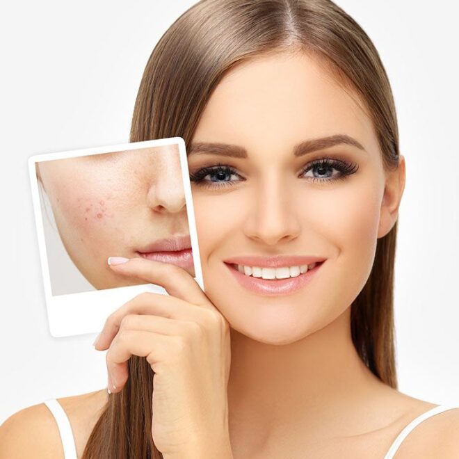 The Role of Hormones in Acne Development