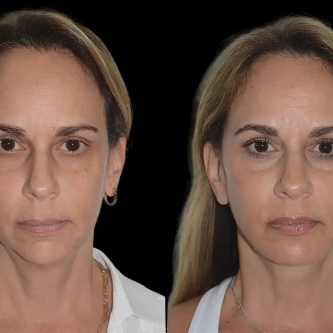 The Latest Trends at the Best Aesthetic Clinic in dubai for Chin Fillers