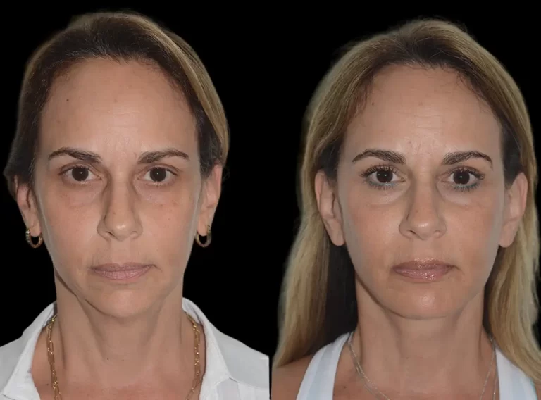 The Latest Trends at the Best Aesthetic Clinic in dubai for Chin Fillers