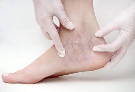 When to See a Doctor About Varicose Veins?