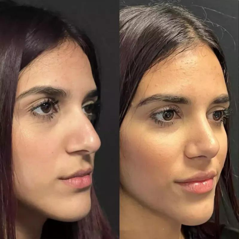 Rhinoplasty in Dubai: Exploring the Latest Techniques and Procedures