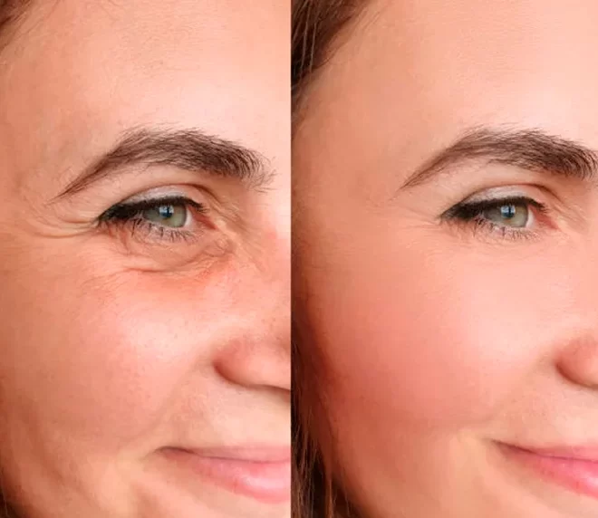 How the Best Doctors in dubai Deliver Natural-Looking Botox Results