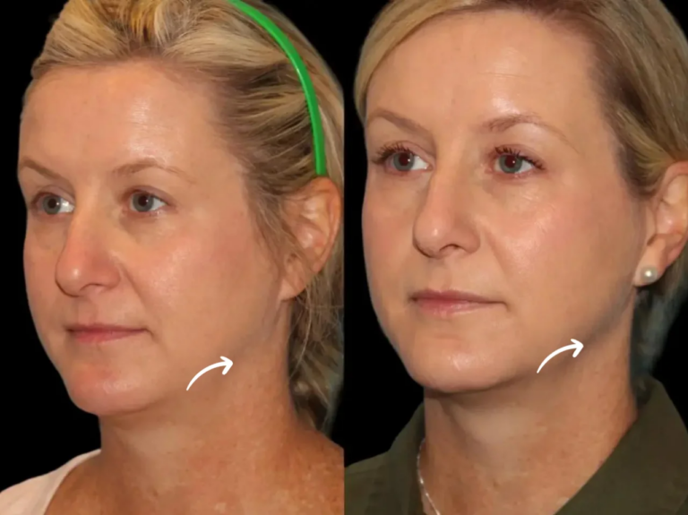 How Sculptra Fillers Treatments in dubai Enhances Youthful Glow