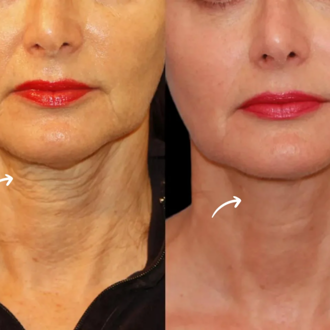 How Sculptra Enhances Skin Elasticity at the Best Aesthetic Clinic in dubai