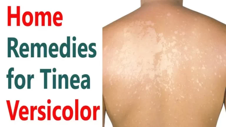 How to Treat Tinea Versicolor Naturally: A Complete Guide