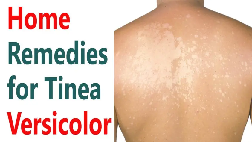 home remedies for Tinea Versicolor 6