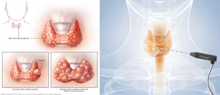 Thyroid Nodules: Navigating Diagnosis, Biopsy, and Treatment Choices