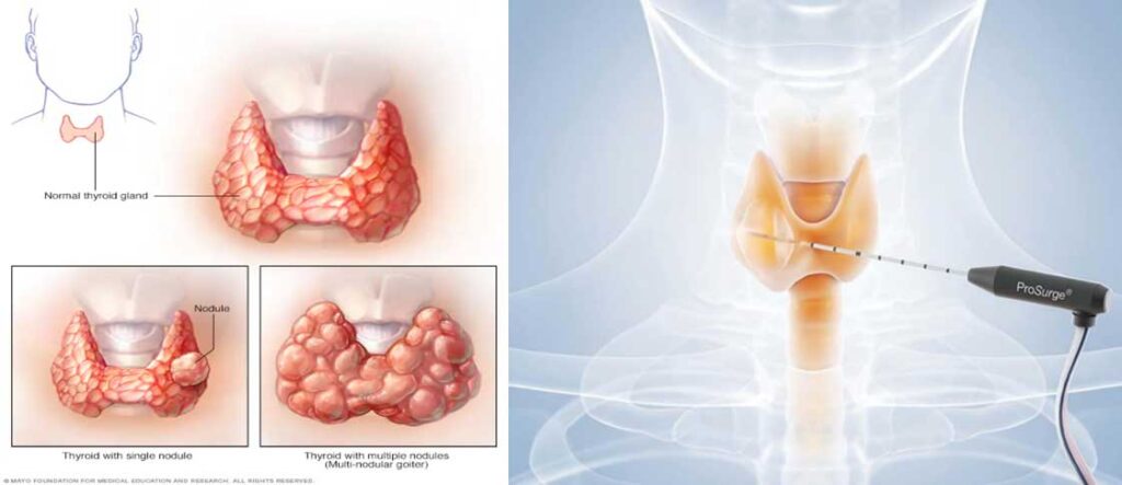 Thyroid nodules