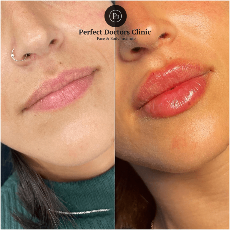 Juvederm for Non-Surgical Chin Enhancement: Best Doctors in dubai