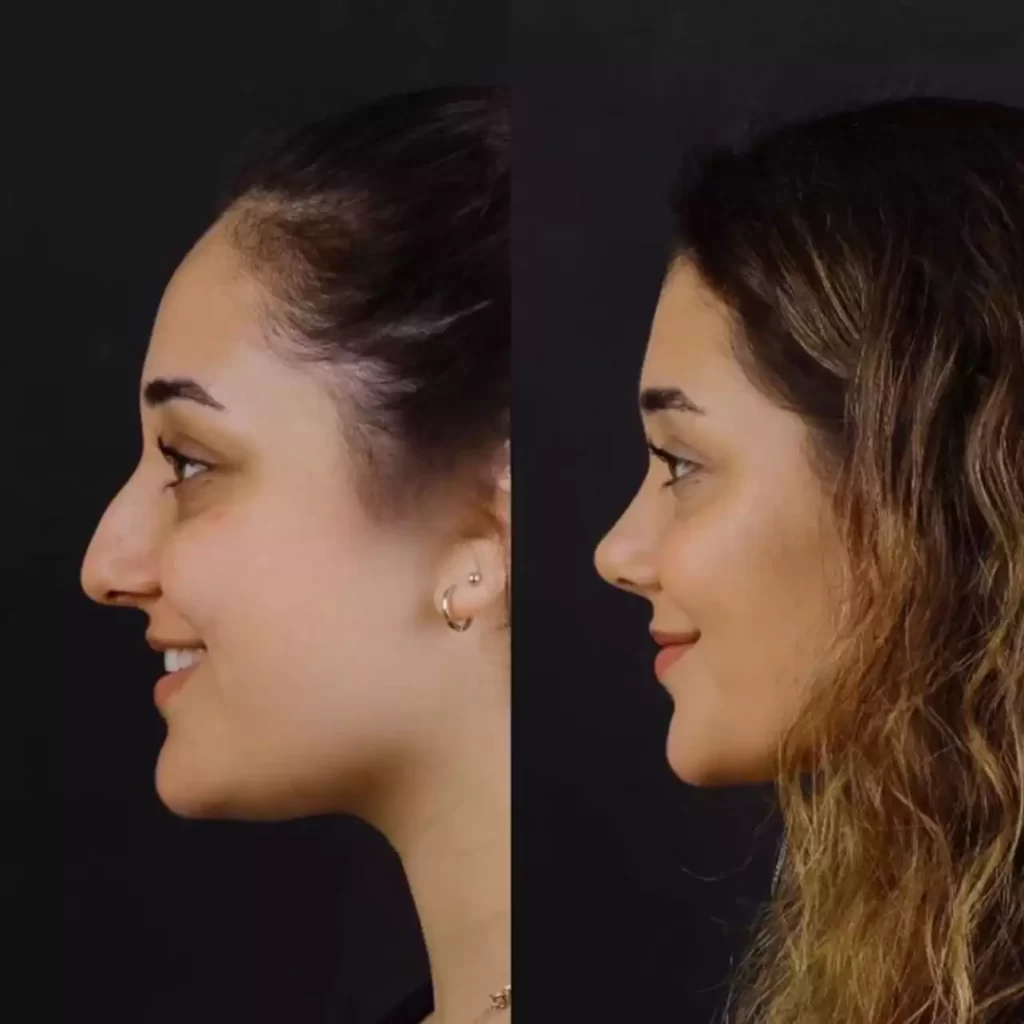 The Benefits of Rhinoplasty in Dubai: Aesthetic and Functional Improvements