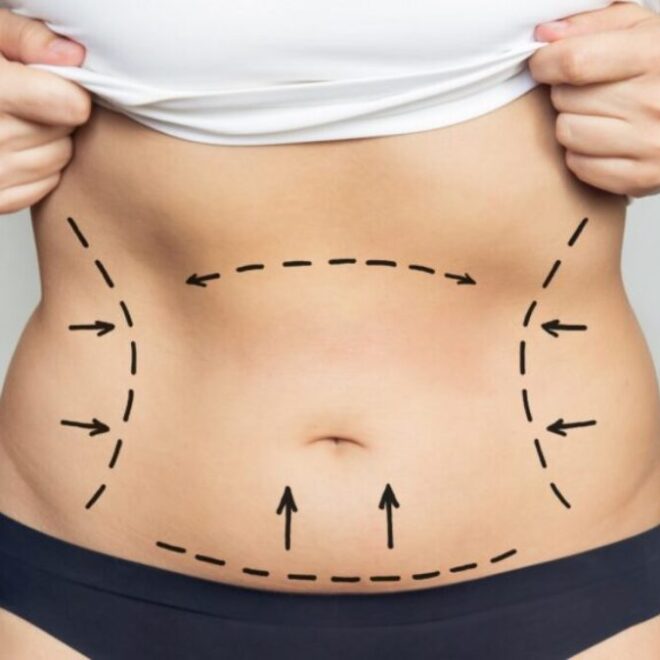 Full Body Liposuction in Dubai Emotional Readiness and Insights