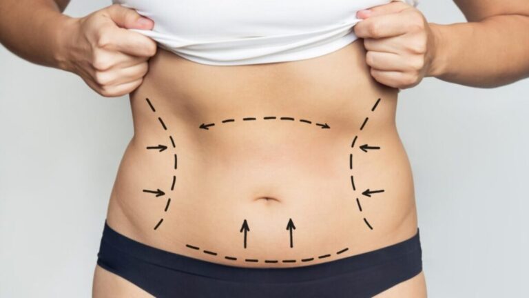 Full Body Liposuction in Dubai Emotional Readiness and Insights