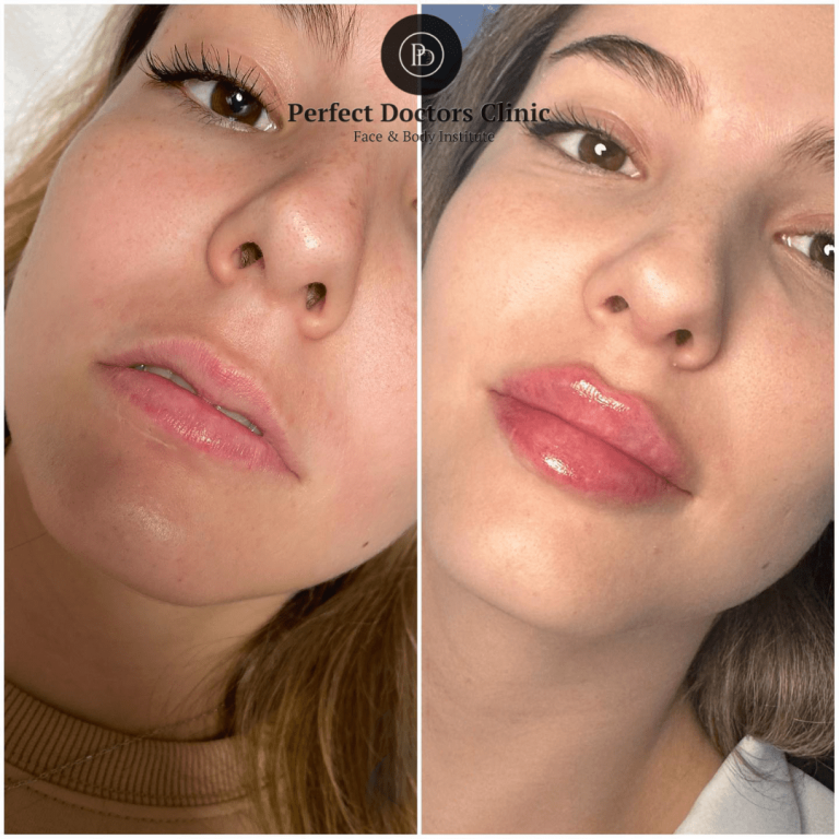 How Juvederm by the Best Doctors in dubai Can Boost Your Confidence