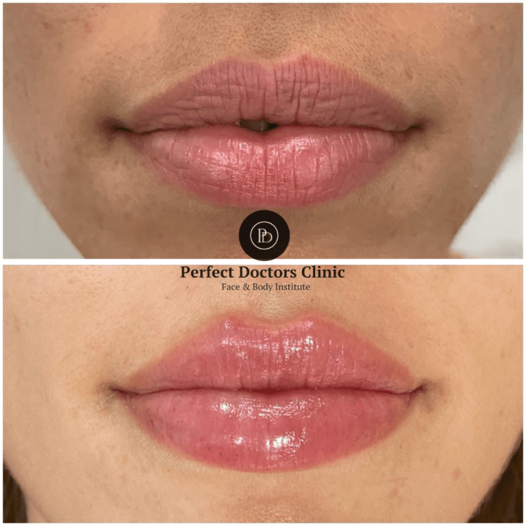 Dermal Fillers for Lip Enhancement: Expertise from the Best Doctors in dubai