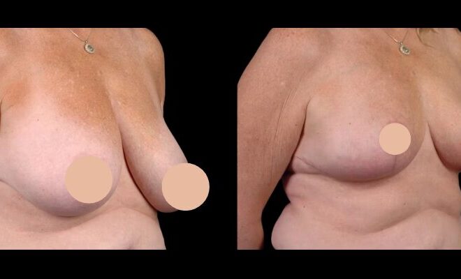 How the Best Breast Reduction Surgeons in dubai Can Help Achieve Natural Results