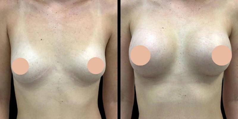 Exploring the Expertise of the Best Breast Augmentation Surgeons in Dubai