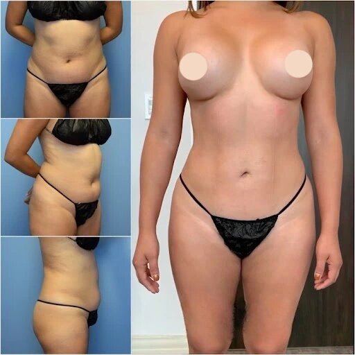 Tummy Tuck in dubai