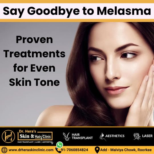 say goodbye to melasma