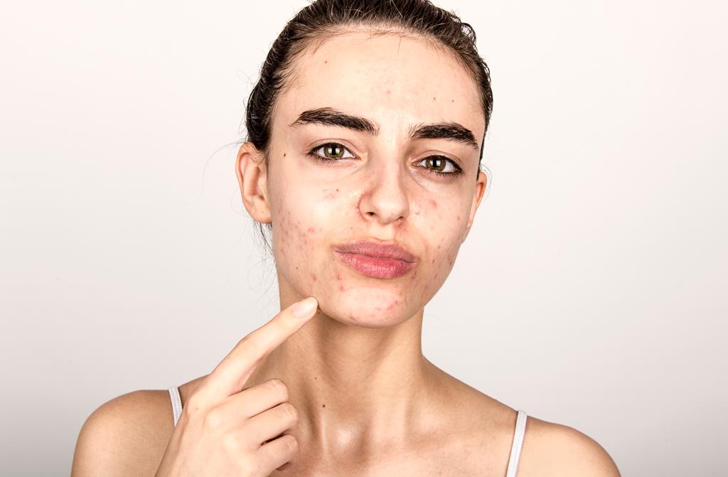 Which Acne Scar Is Hardest to Treat?