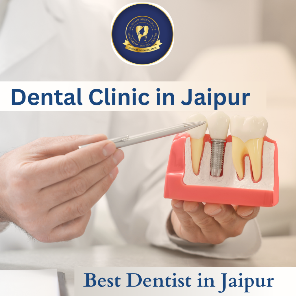 Best Dental Implant in Jaipur