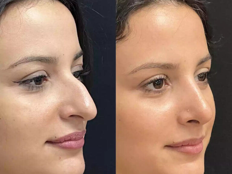 Understanding the Cost of Nose Surgery in Dubai