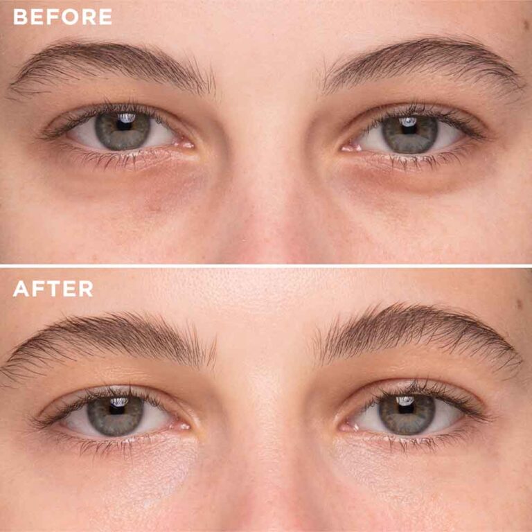 Is It Possible to Get an Instant Eye Lift Without Injections?