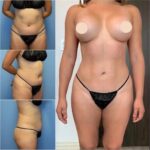Get the Perfect Body with the Expertise of the Best Body Contouring Surgeon in dubai