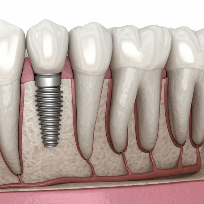 Why Dental Implant Systems Are Revolutionizing Modern Dentistry