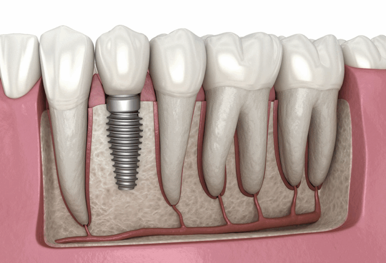 Why Dental Implant Systems Are Revolutionizing Modern Dentistry