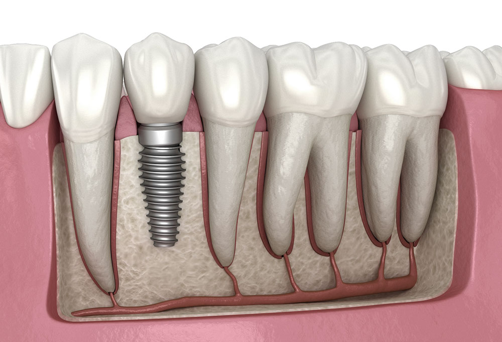 dental implant systems