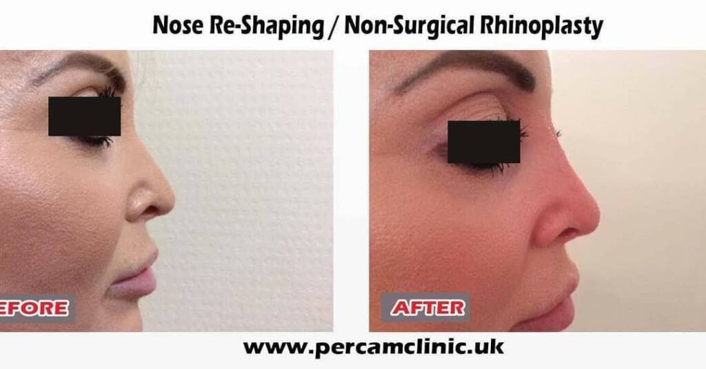 non-surgical cosmetic treatment