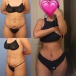 How the Best Tummy Tuck Surgeon in dubai Guarantees Results