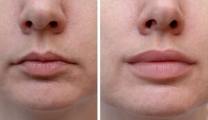 Lip Fillers: What to Expect Before, During, and After Your Lip Filler Treatment