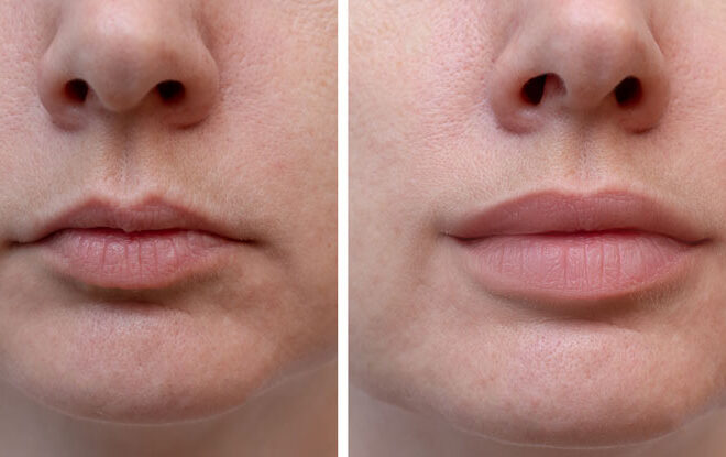 Lip Fillers: What to Expect Before, During, and After Your Lip Filler Treatment