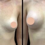 Is Breast Augmentation in Dubai Safe A Look at the Latest Trends and Techniques