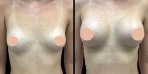 Is Breast Augmentation in Dubai Safe A Look at the Latest Trends and Techniques