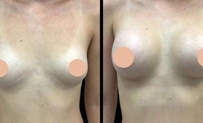 Is Breast Augmentation in Dubai Safe A Look at the Latest Trends and Techniques