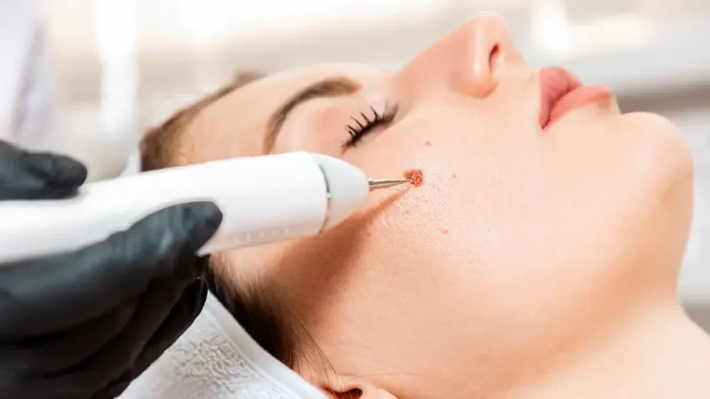 laser skin tag removal over freezing.