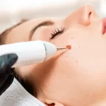 What Makes Laser Removal Better Than Freezing?
