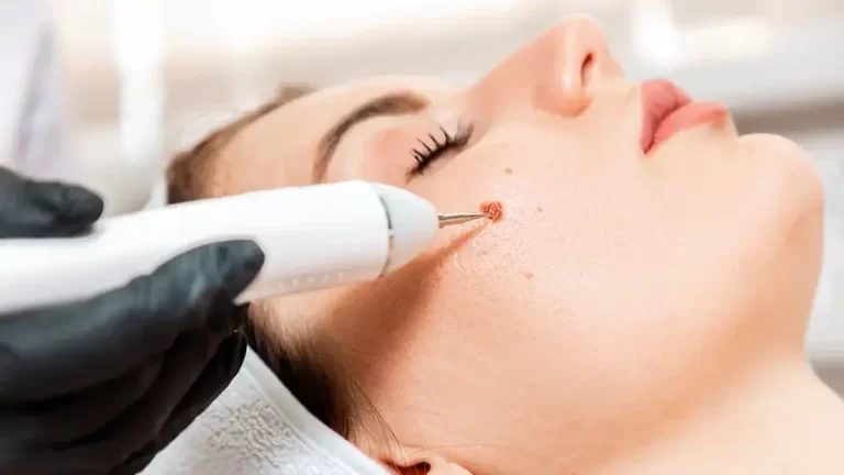 What Makes Laser Removal Better Than Freezing?