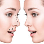 Top Clinics for Nose Fillers in Dubai: What You Need to Know