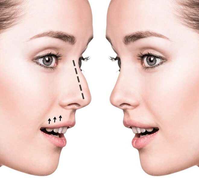 Top Clinics for Nose Fillers in Dubai: What You Need to Know