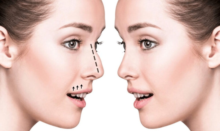Top Clinics for Nose Fillers in Dubai: What You Need to Know
