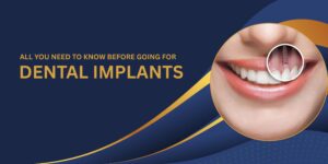 All you need to know before going for dental implants