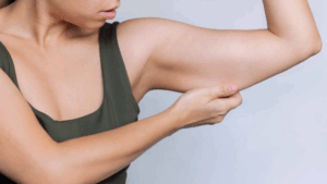 Is Arm Lift the Answer to Bat Wings?