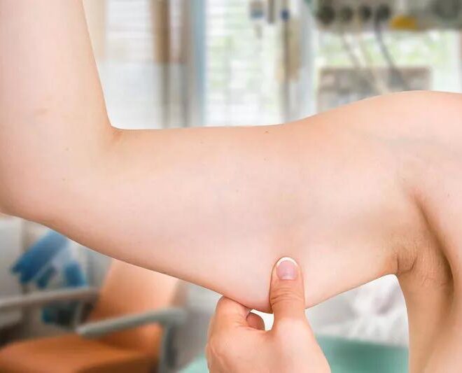 Will I have scars after arm lift surgery?