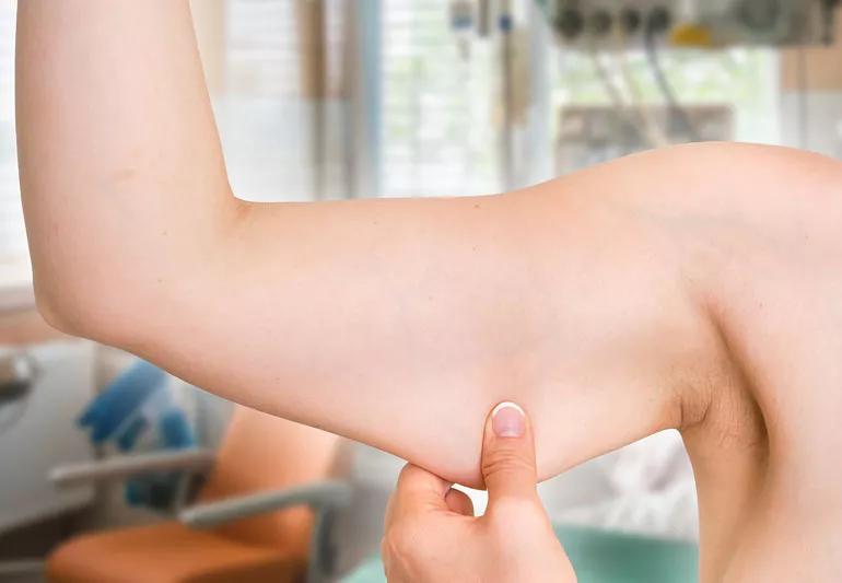 Arm lift Surgery