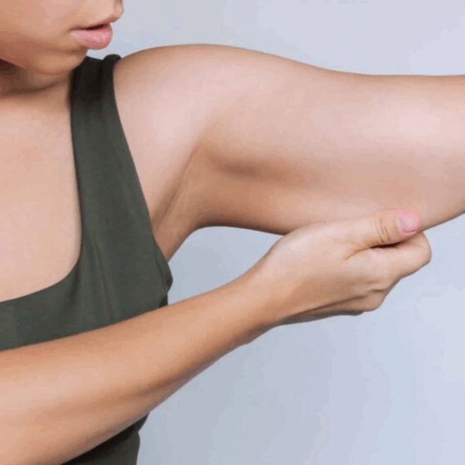 Is Arm Lift the Answer to Bat Wings?