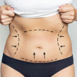 The Cost of a Mini Tummy Tuck in Dubai: Affordable Body Contouring Options