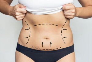 The Cost of a Mini Tummy Tuck in Dubai: Affordable Body Contouring Options
